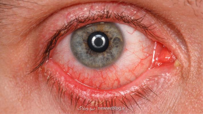 مشاهده شواهدی در خصوص ابتلای سلول های چشم به كووید-۱۹