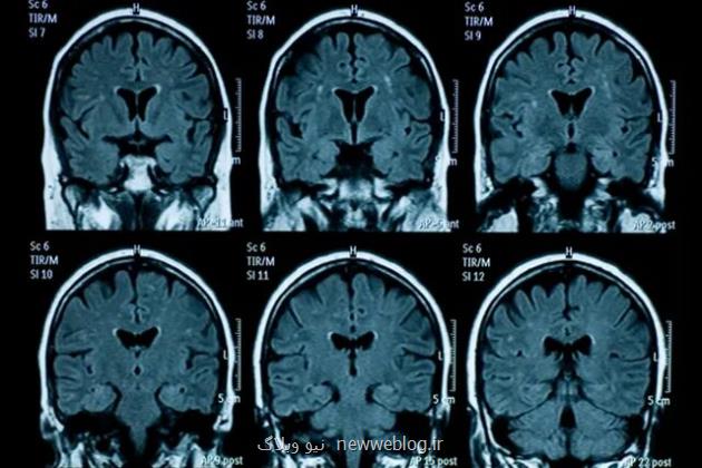 پیری زودرس مغز نوجوانان به دنبال قرنطینه کووید-۱۹