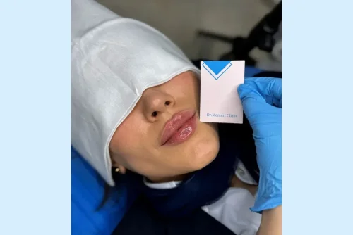 استفاده از فیلر لب چه تاثیری در زیبایی صورت دارد؟