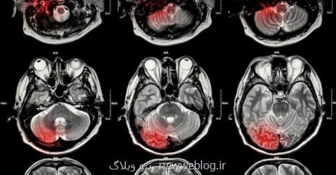 خارج كردن تومورهای مغزی با یك روش نوین