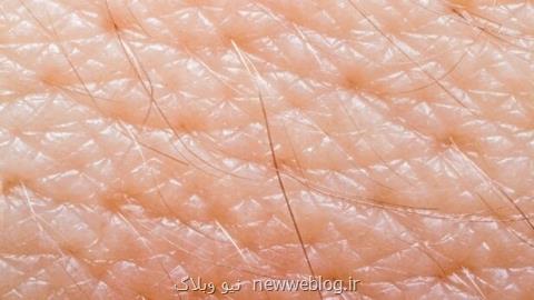 تشخیص استعداد مبتلا شدن به بیماری روانی با آزمایش پوست!